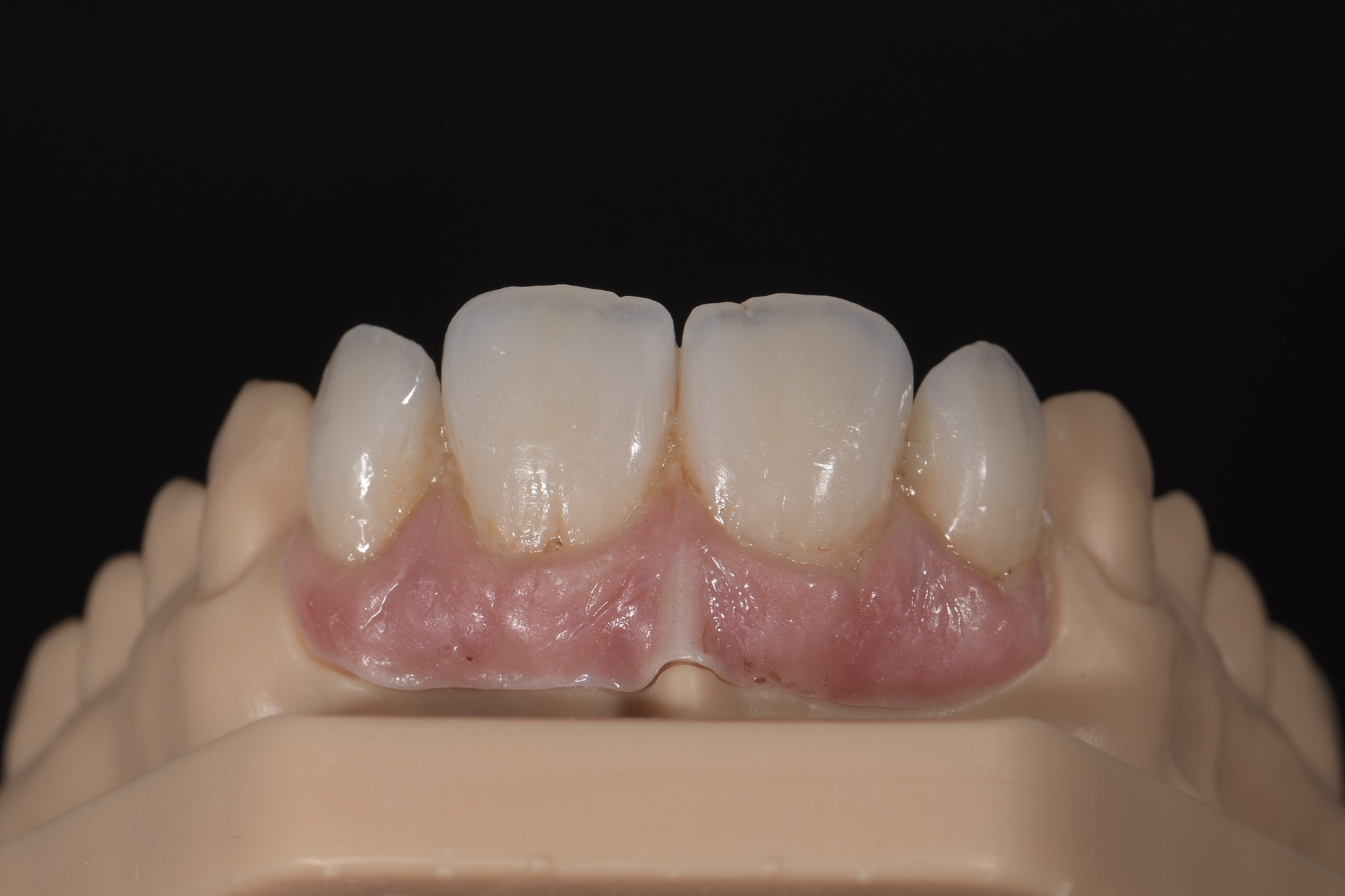 Détail d’une réalisation de prothèse dentaire Oral Arts