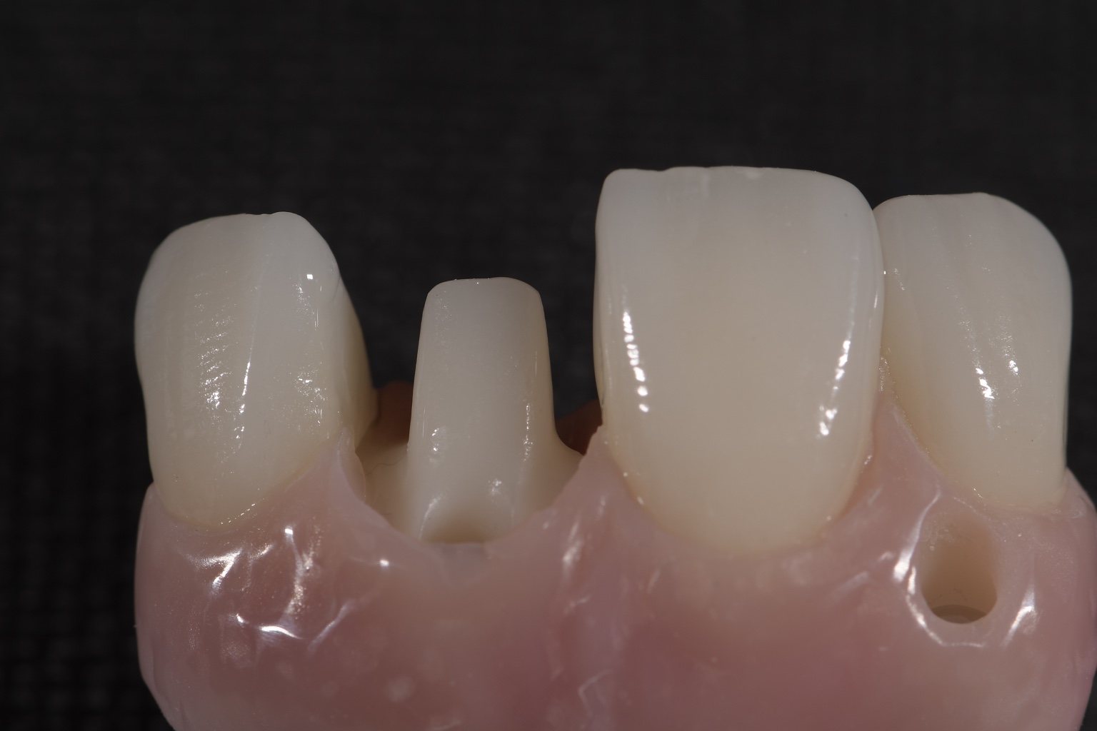 Prothèse antérieure avec un élément séparé
