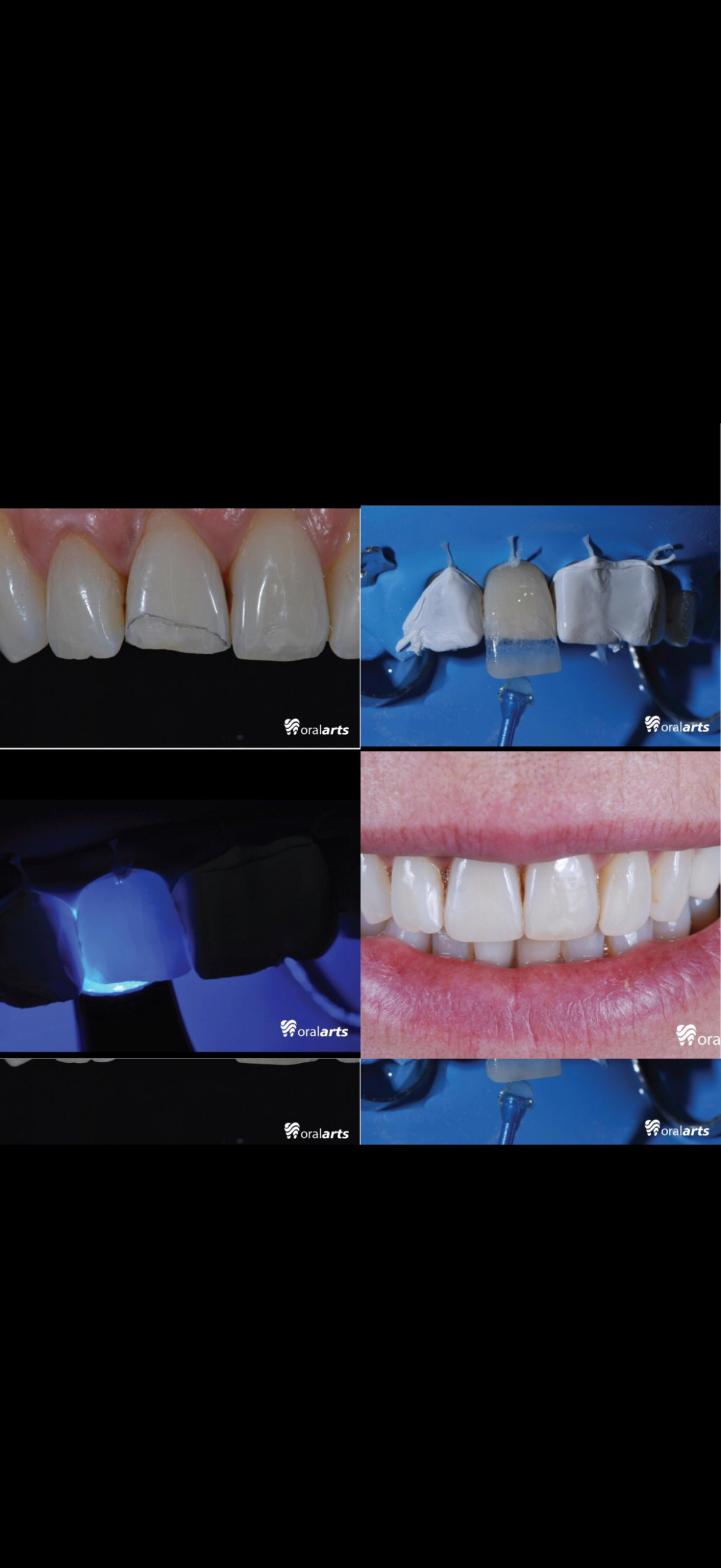 Étapes de restauration d’une incisive sous digue et sourire